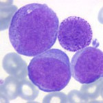leucemia-150x150.jpg