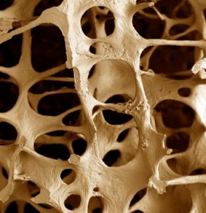 osteoporosi-290x300.jpg